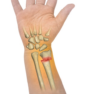 Forearm Fractures in Children